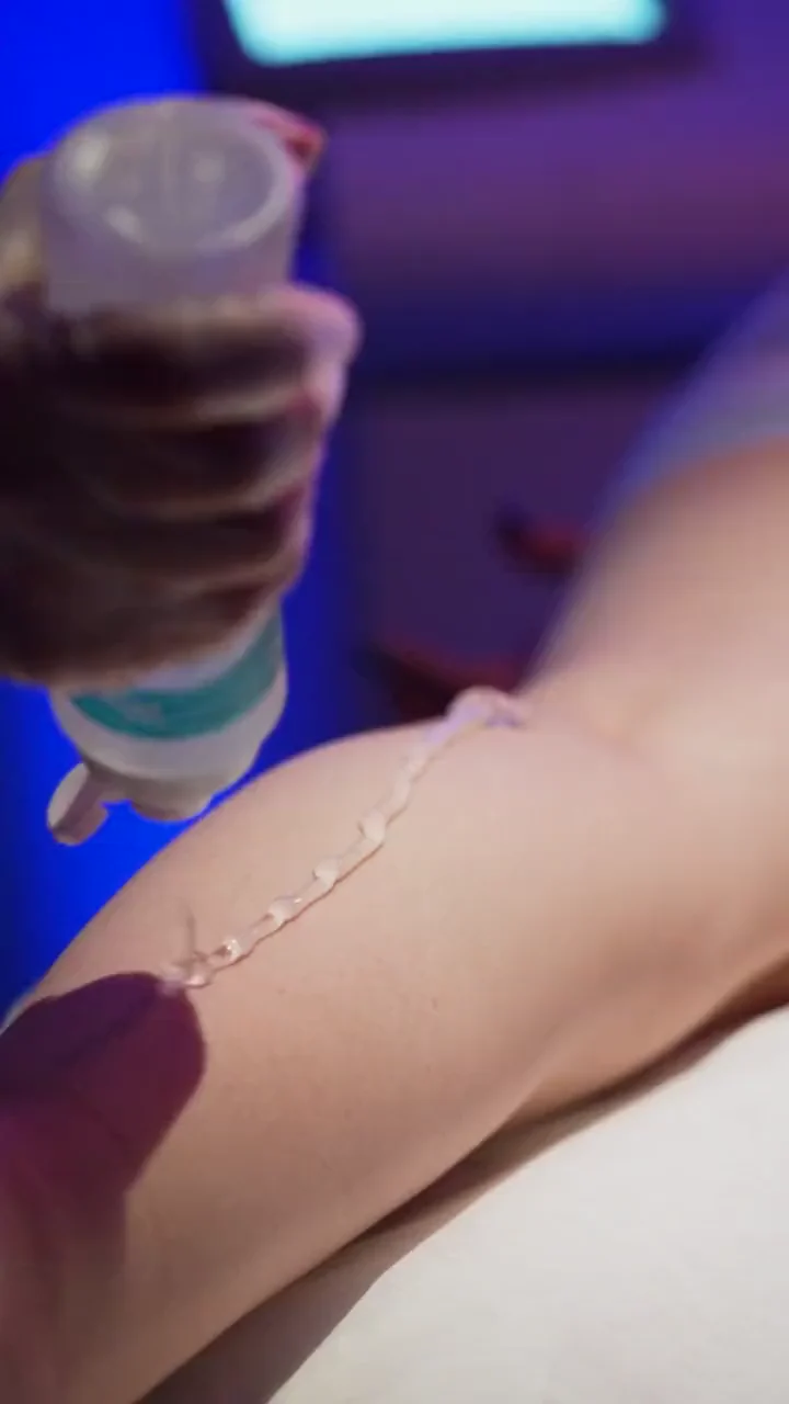 Cooling gel applied to the leg before a laser session